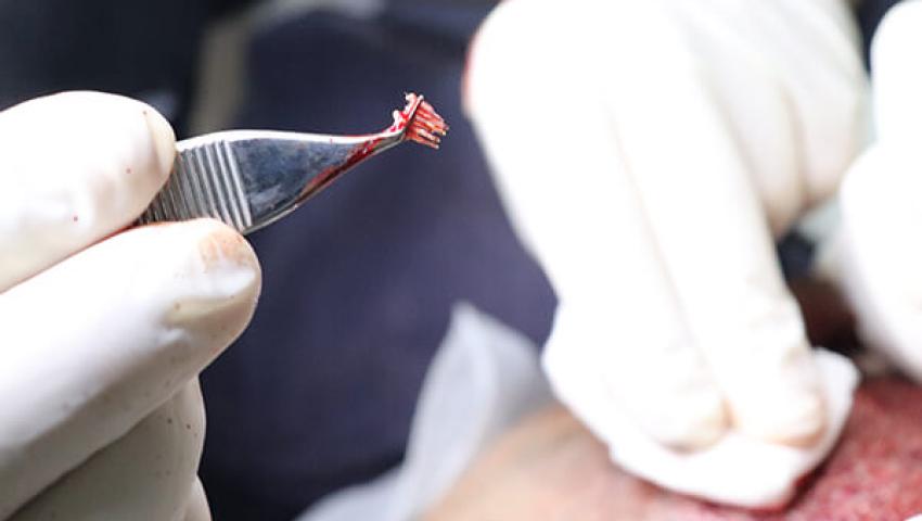 DHI Saç Ekimi - Hair Of Tatvan