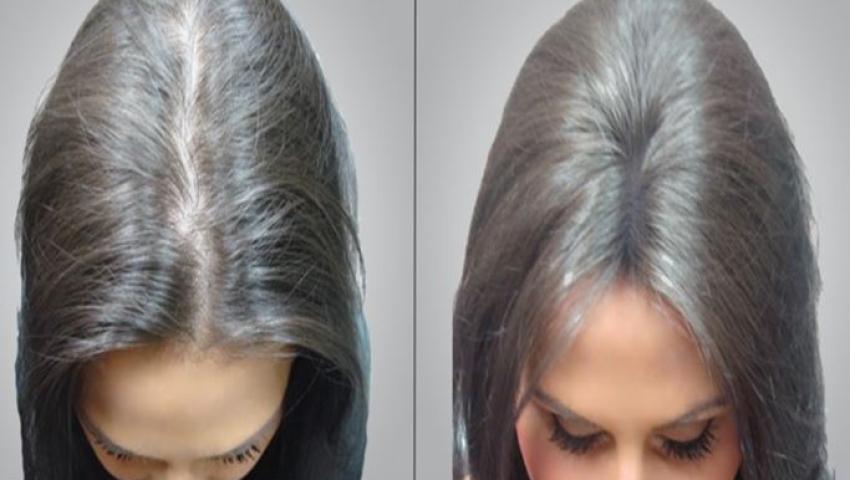 Kadınlar İçin Saç Ekimi