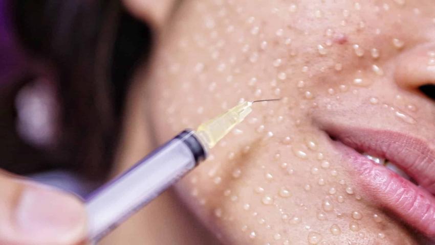 Yüz Mezoterapisi: Cildinizi Gençleştirin ve Yenileyin